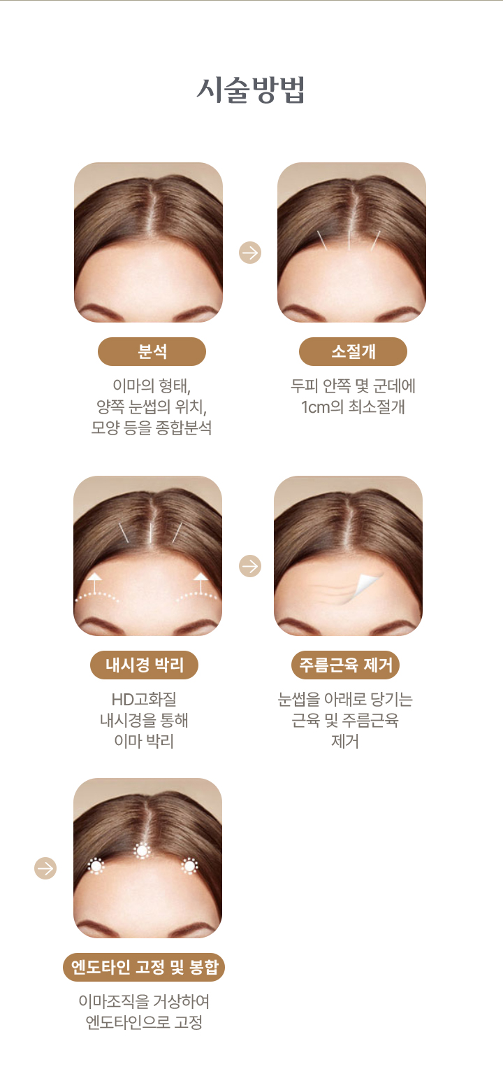 시술방법