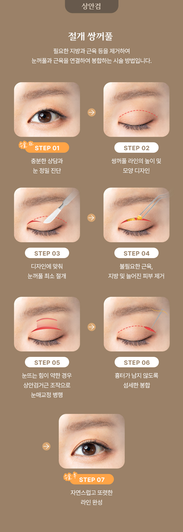 절개 쌍커풀