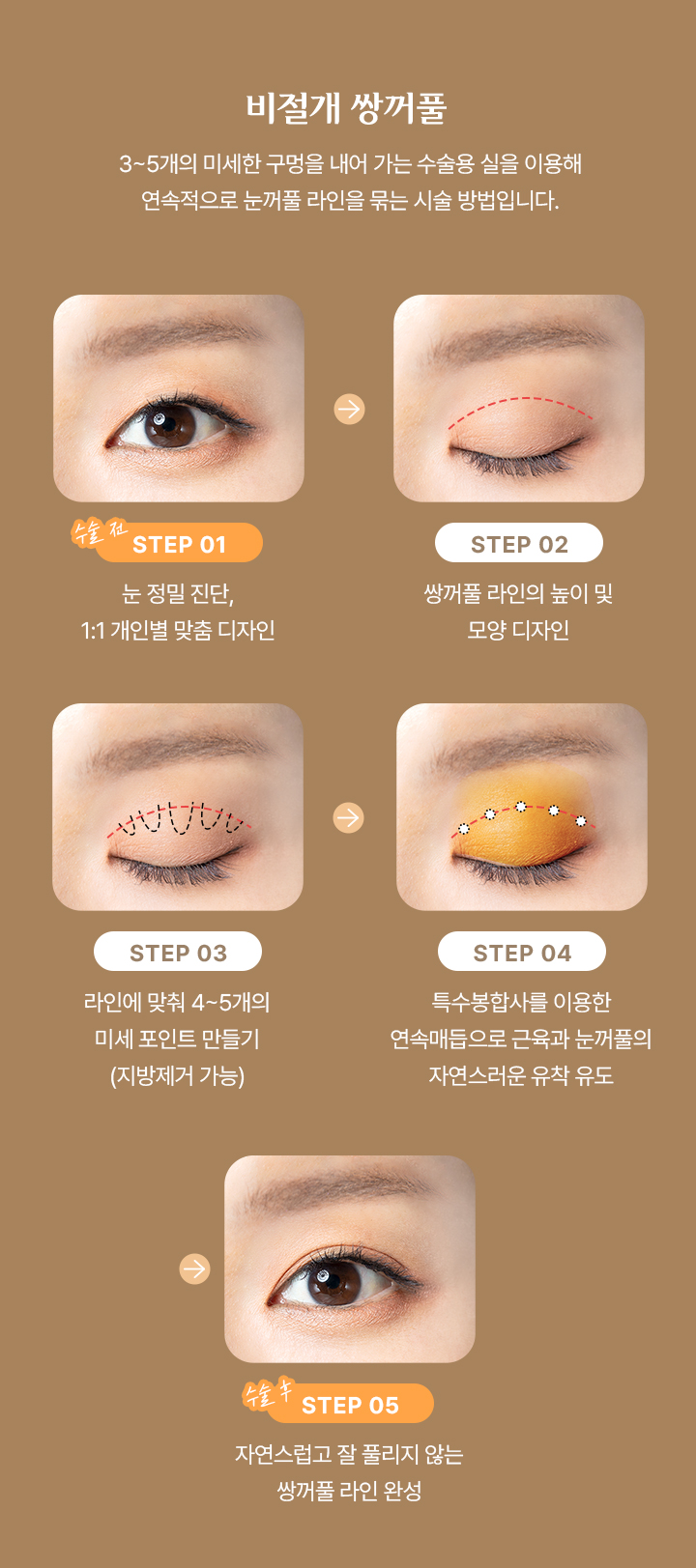 비절개 쌍커풀