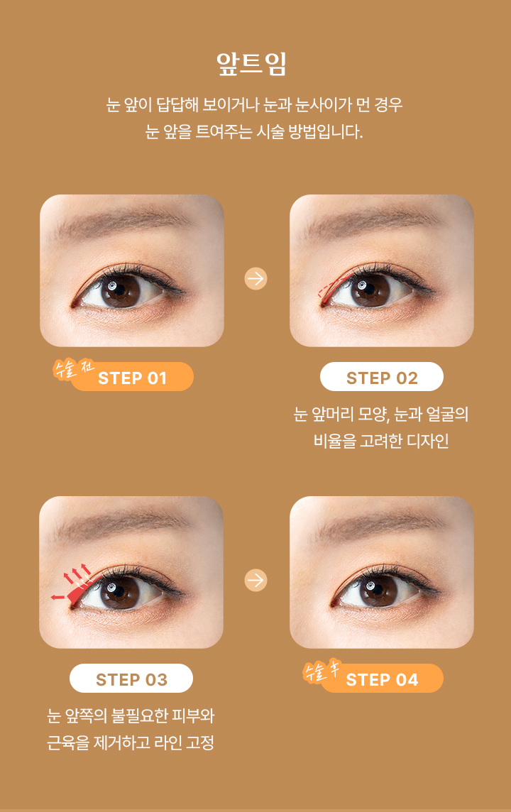 앞트임