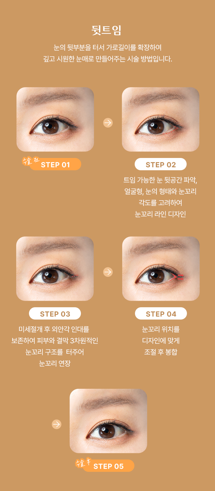 뒷트임