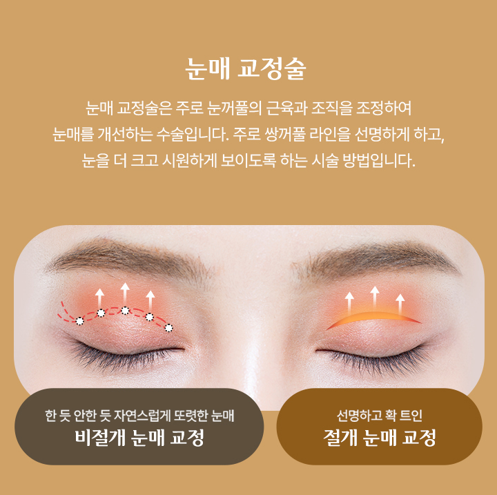 눈매교정술