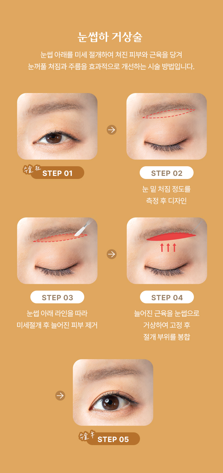 눈썹하 거상술