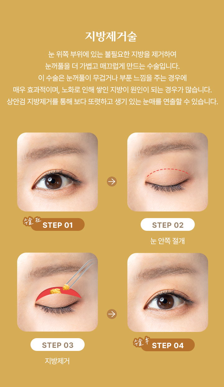 지방 제거술