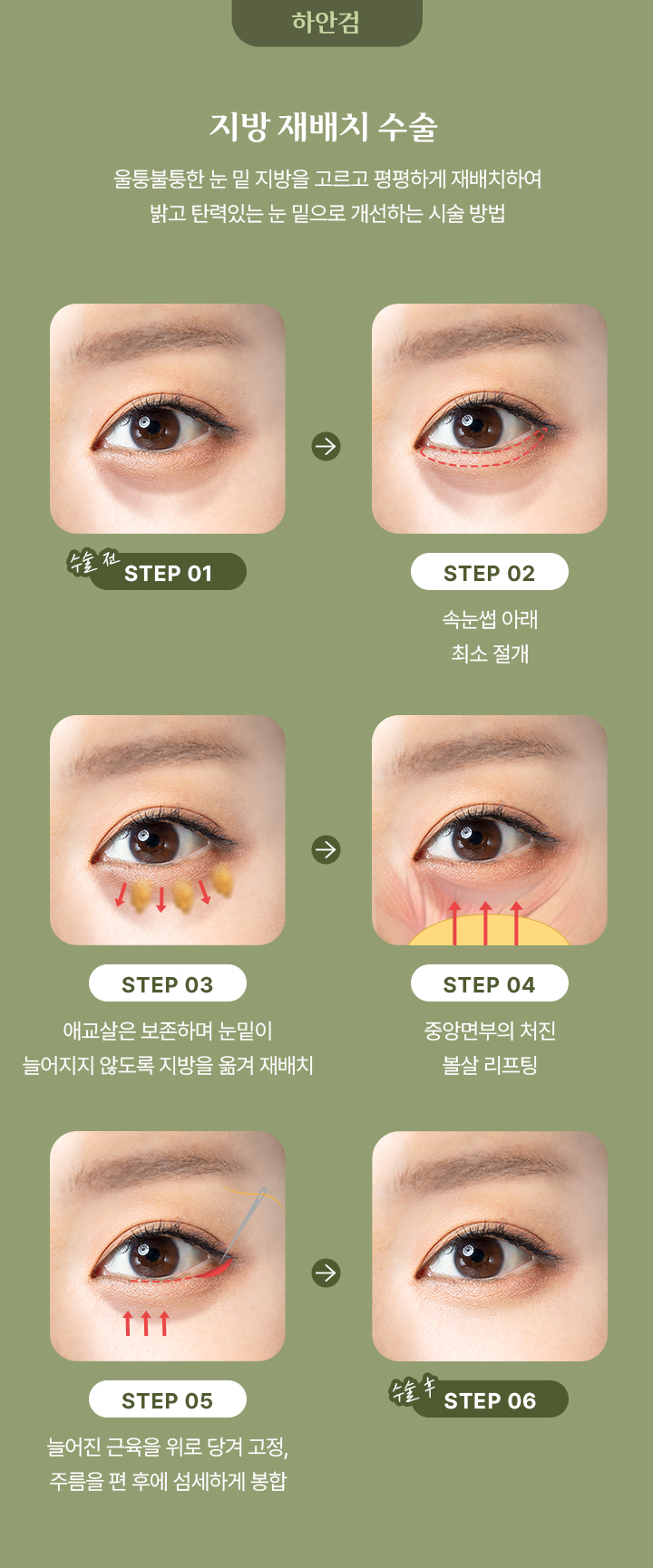 지방 재배치 수술