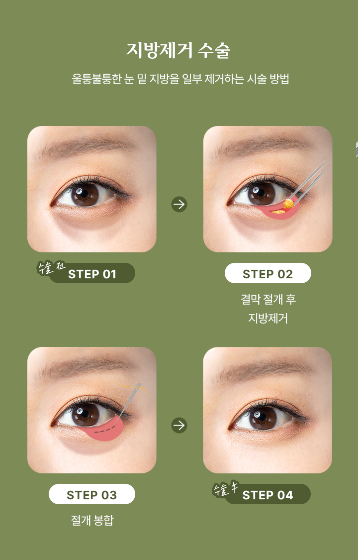 지방 제거 수술