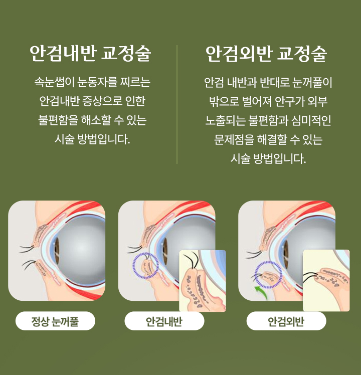 안검내반 교정술 및 안검내반 교정술