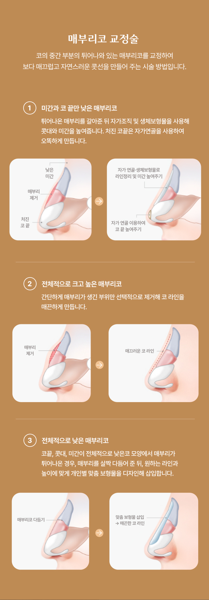 매부리 코 교정술