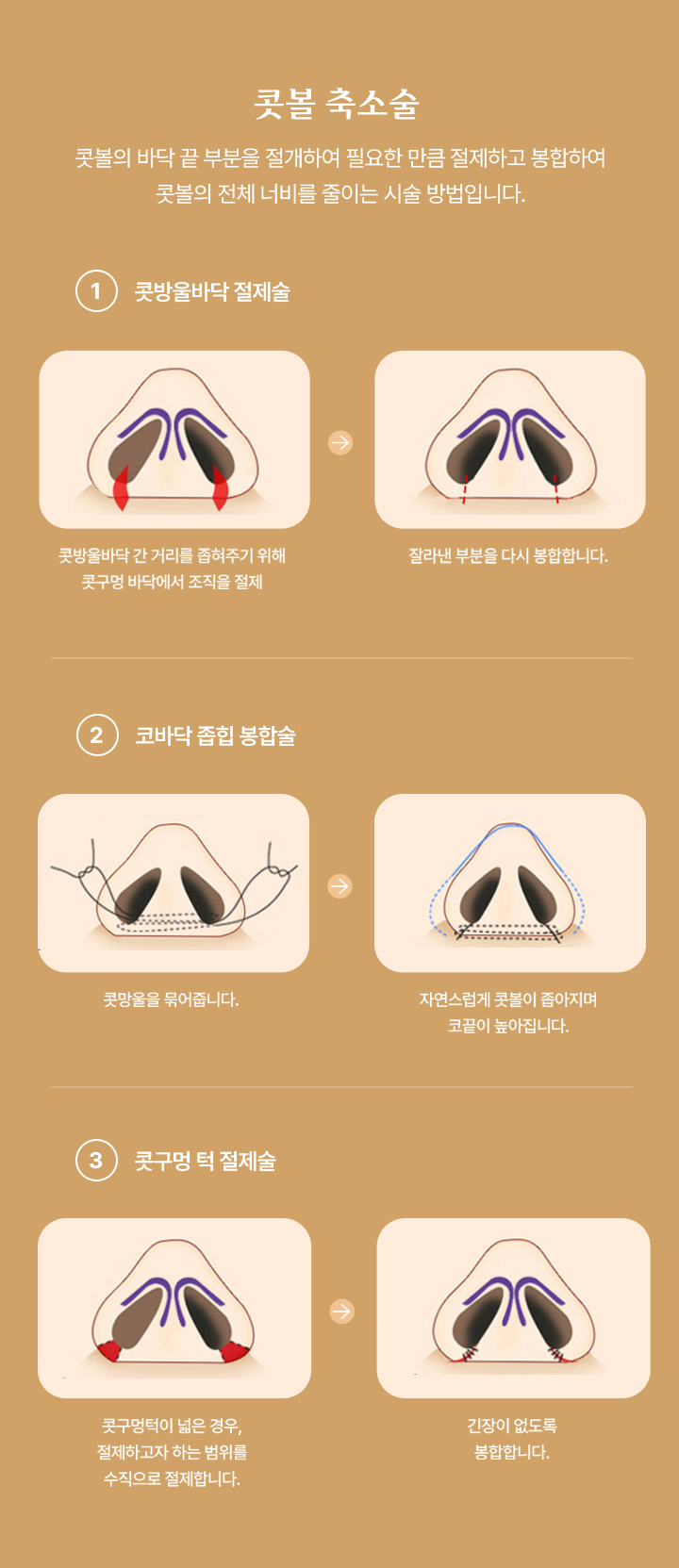 콧볼 축소술