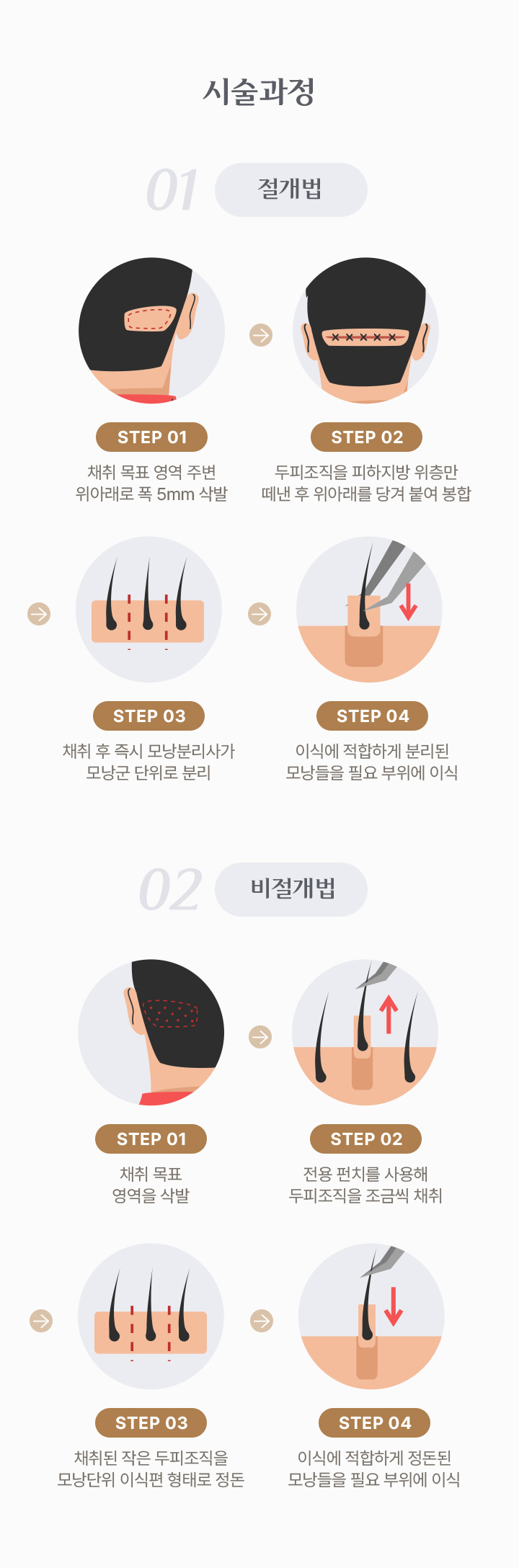 모발이식 시술과정
