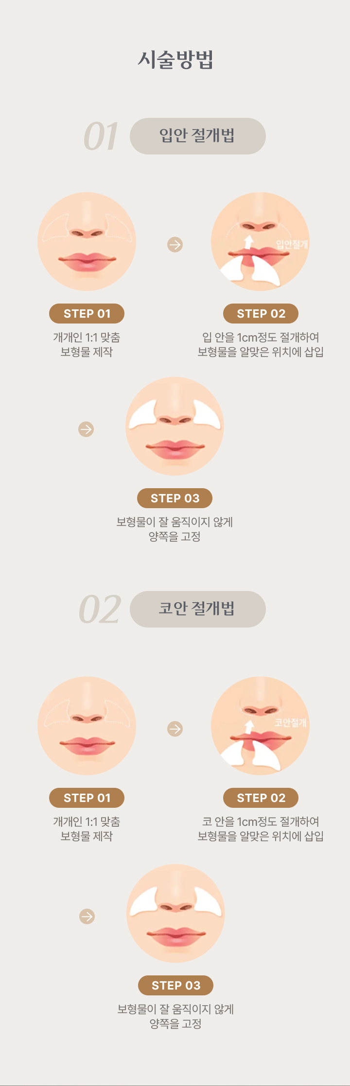 귀족수술 시술방법