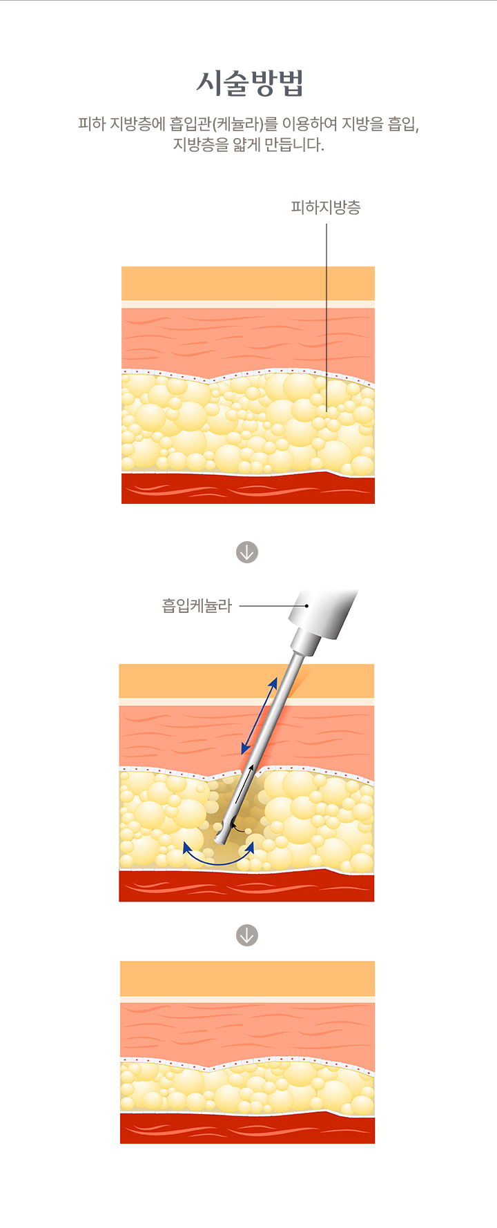 지방흡입술 시술방법 