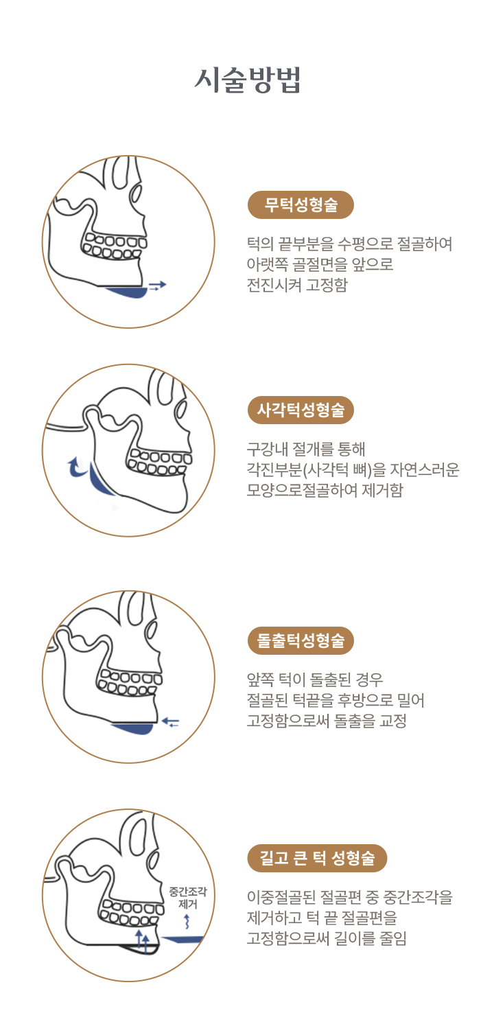턱성형술 시술방법 