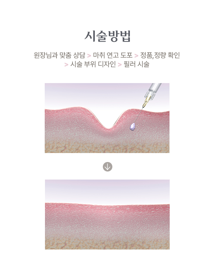필러 시술방법 