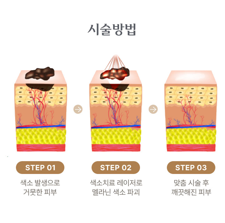 시술 방법 