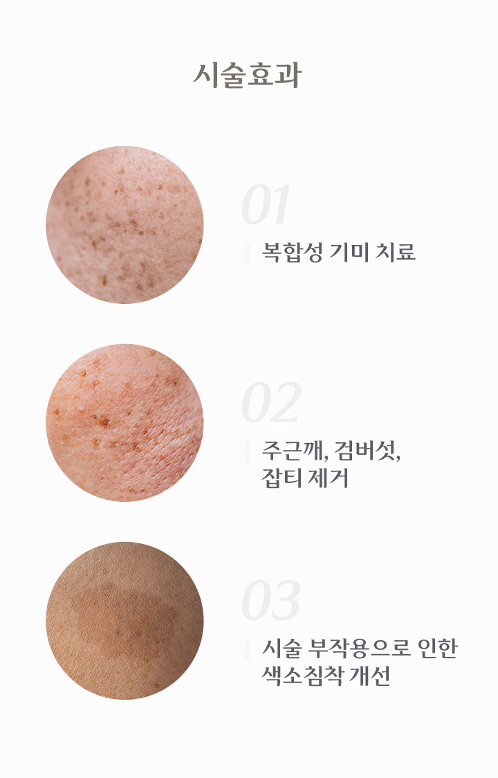 복합성 기미치료 , 주근깨/검버섯/잡티 제거