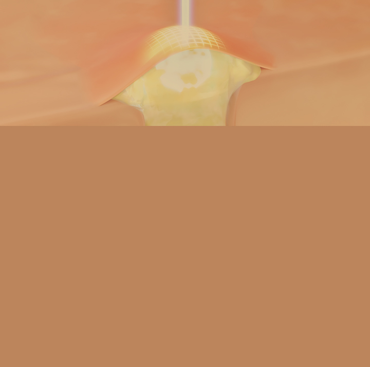 혈관레이저란?