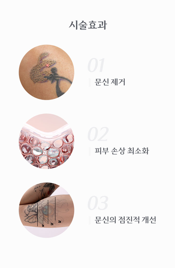 문신제거, 피부손상 최소화
