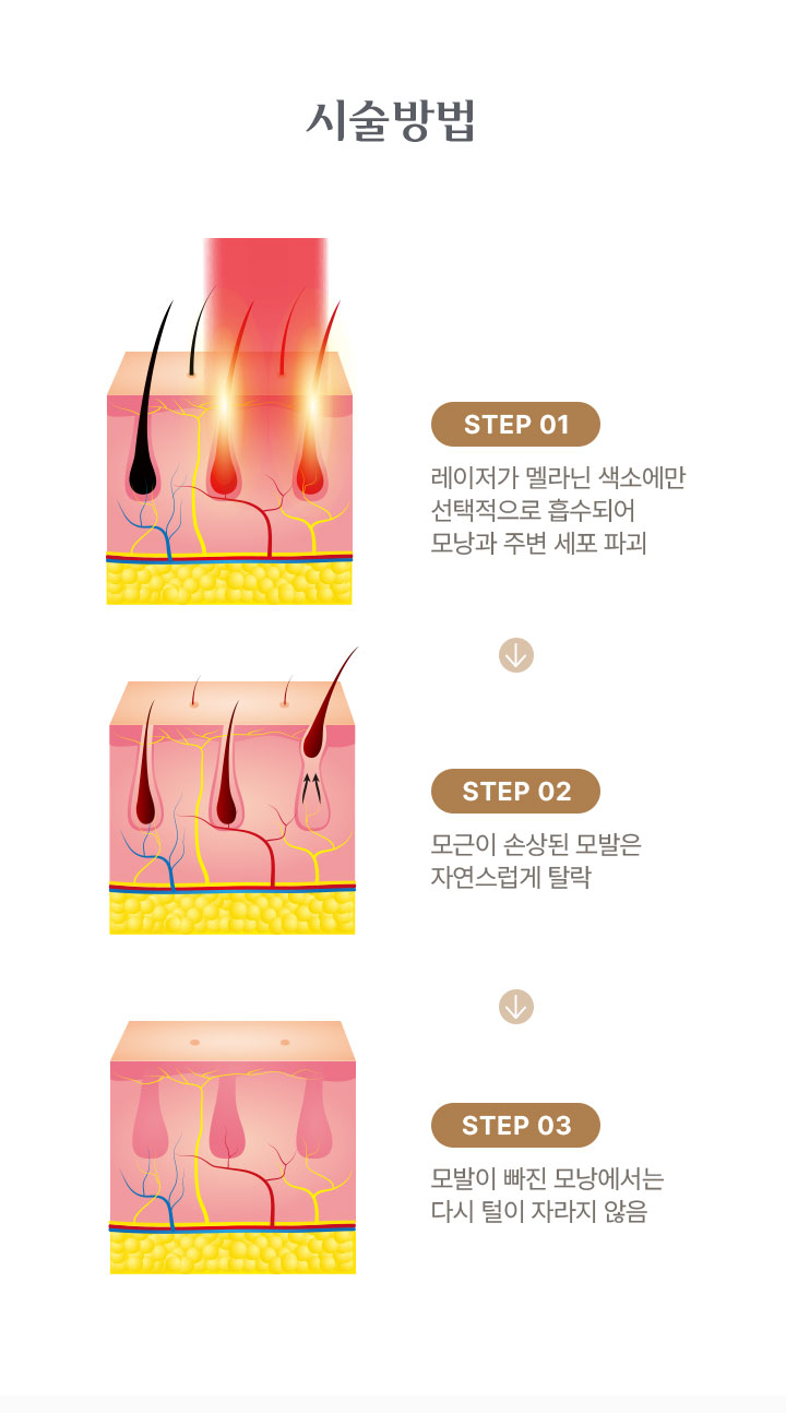시술 방법