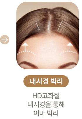 내시경 박리