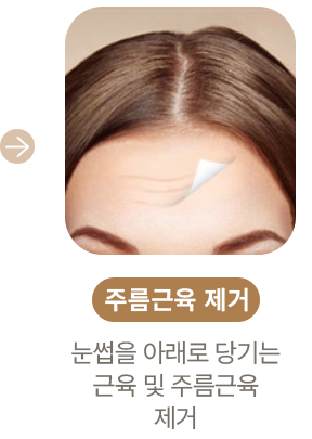 주름근육 제거