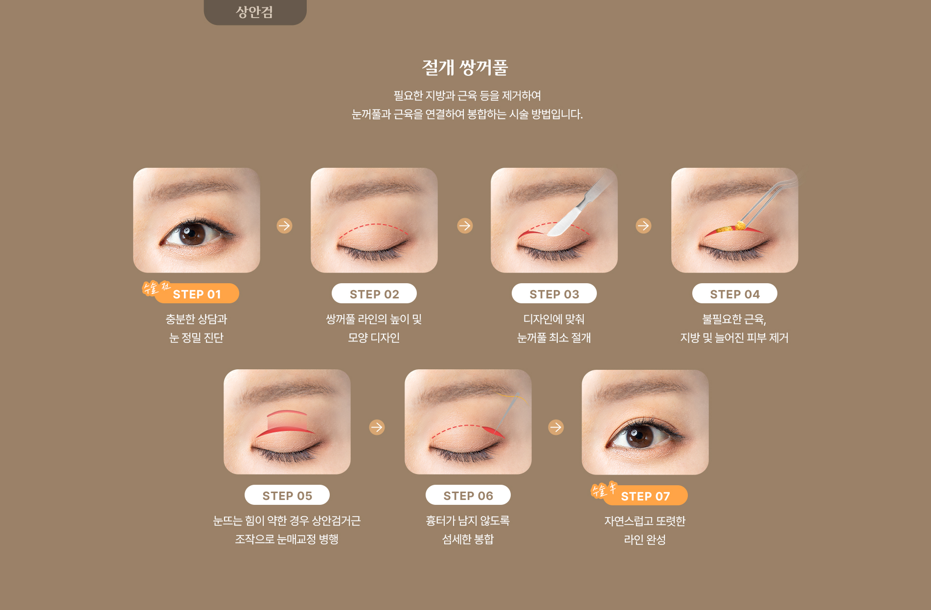 절개 쌍커풀