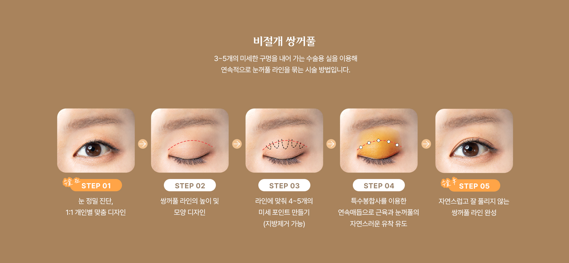 비절개 쌍커풀