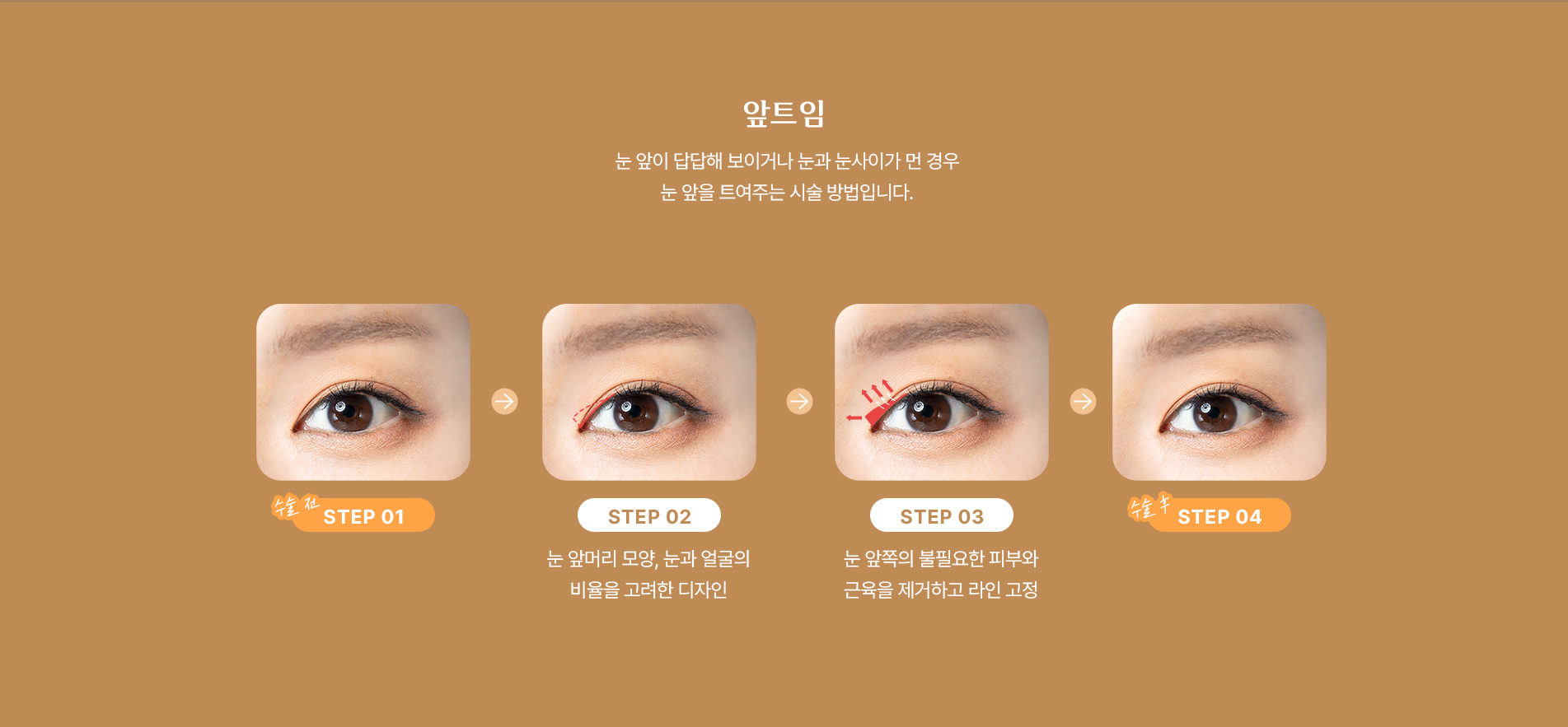 앞트임