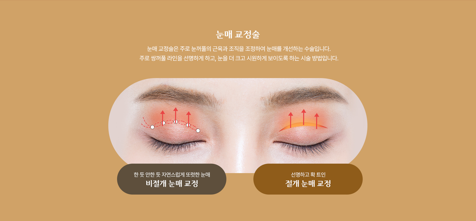 눈매교정술