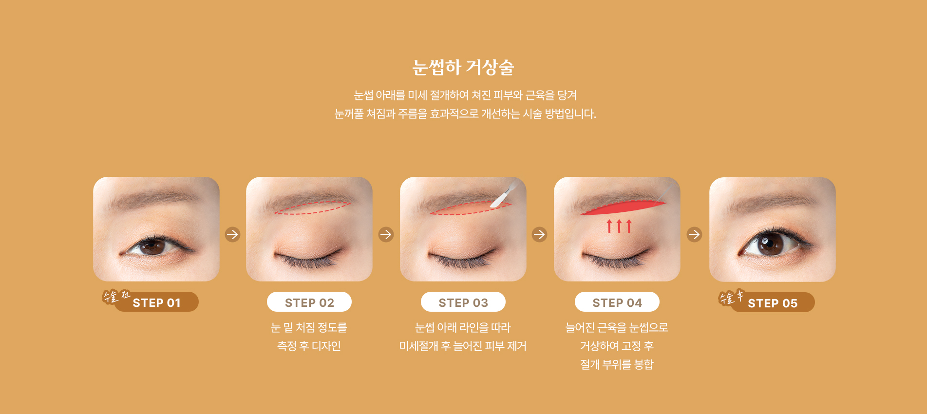 눈썹하 거상술