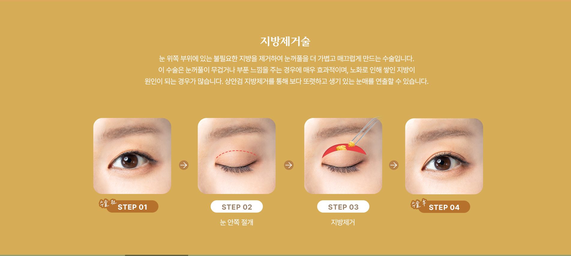 지방 제거술