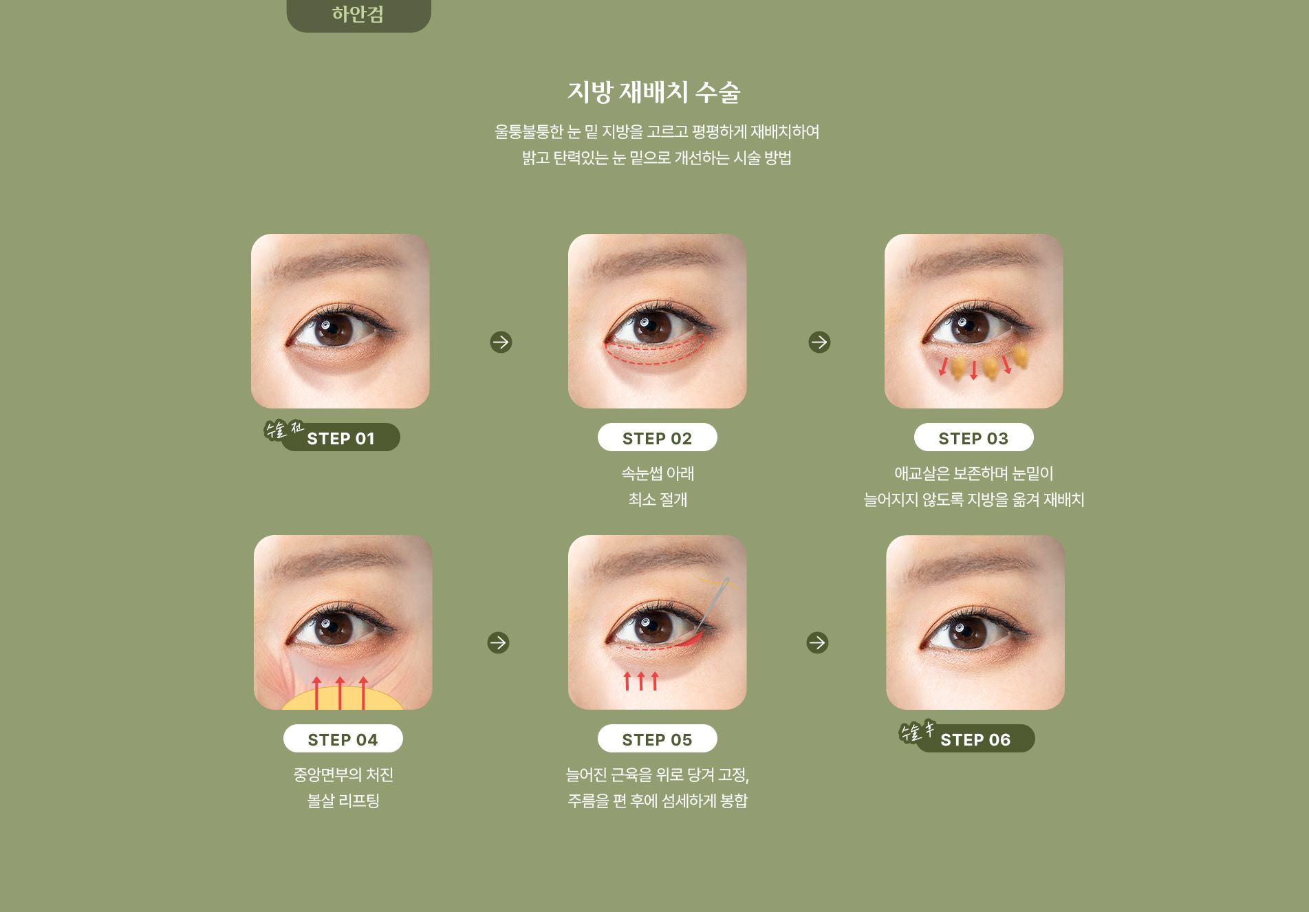 지방 재배치 수술