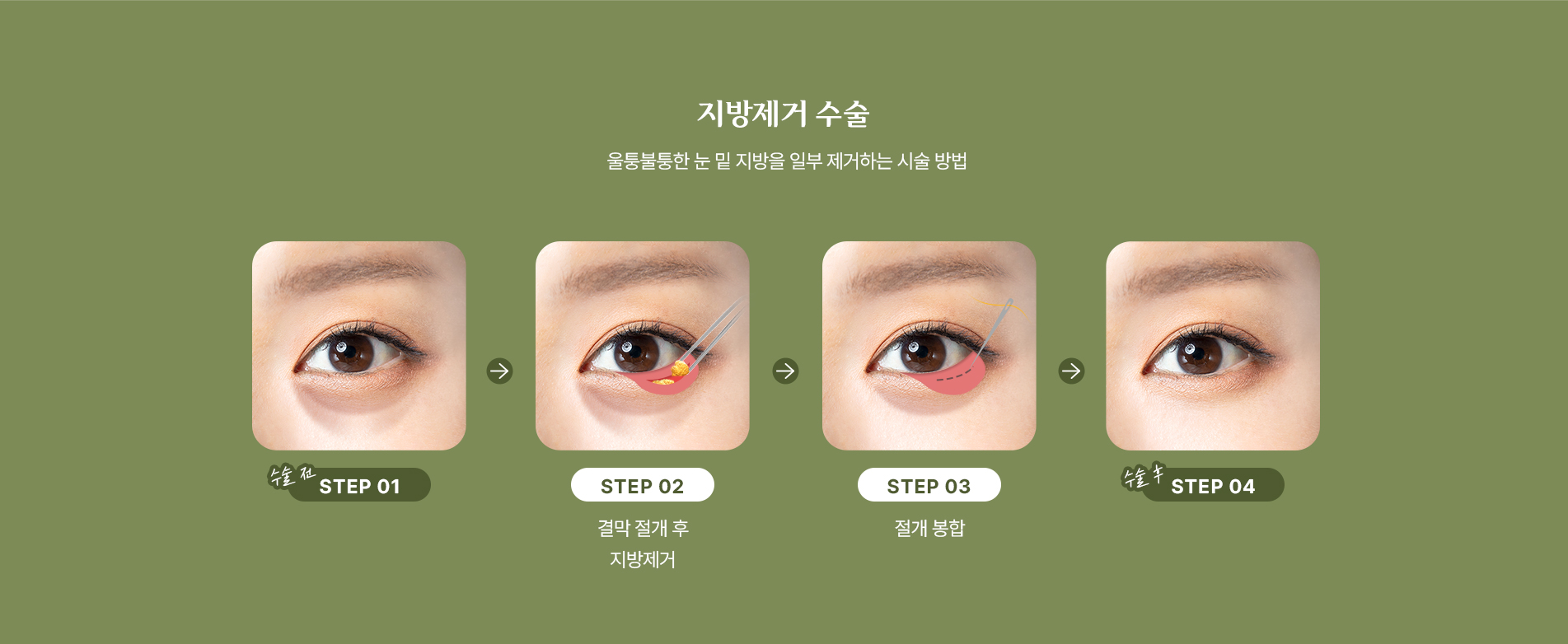 지방 제거 수술