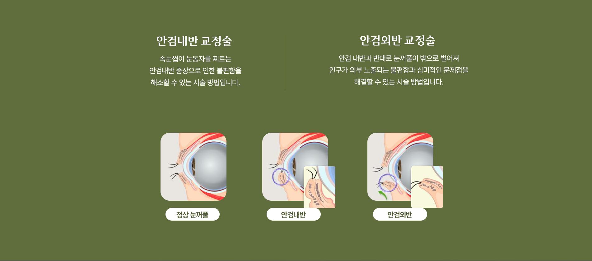 안검내반 교정술 및 안검내반 교정술