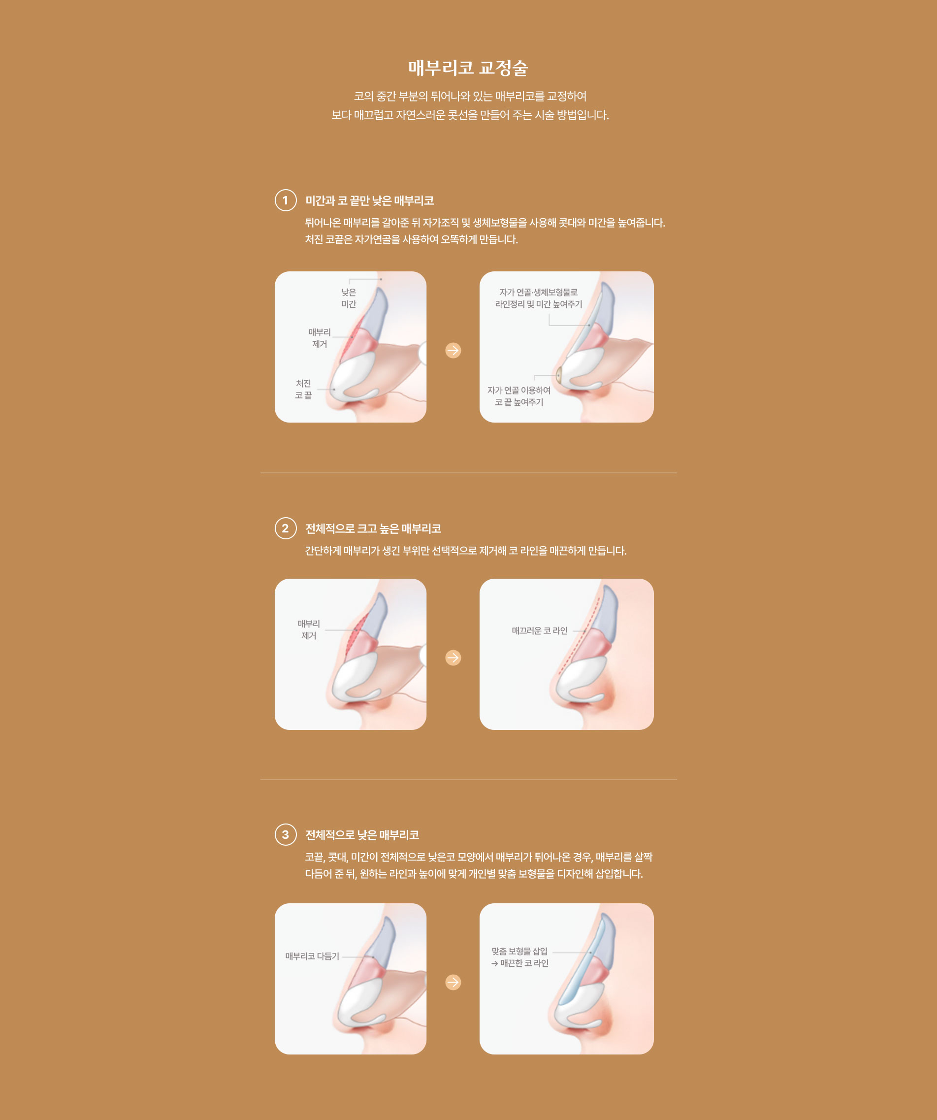 매부리 코 교정술