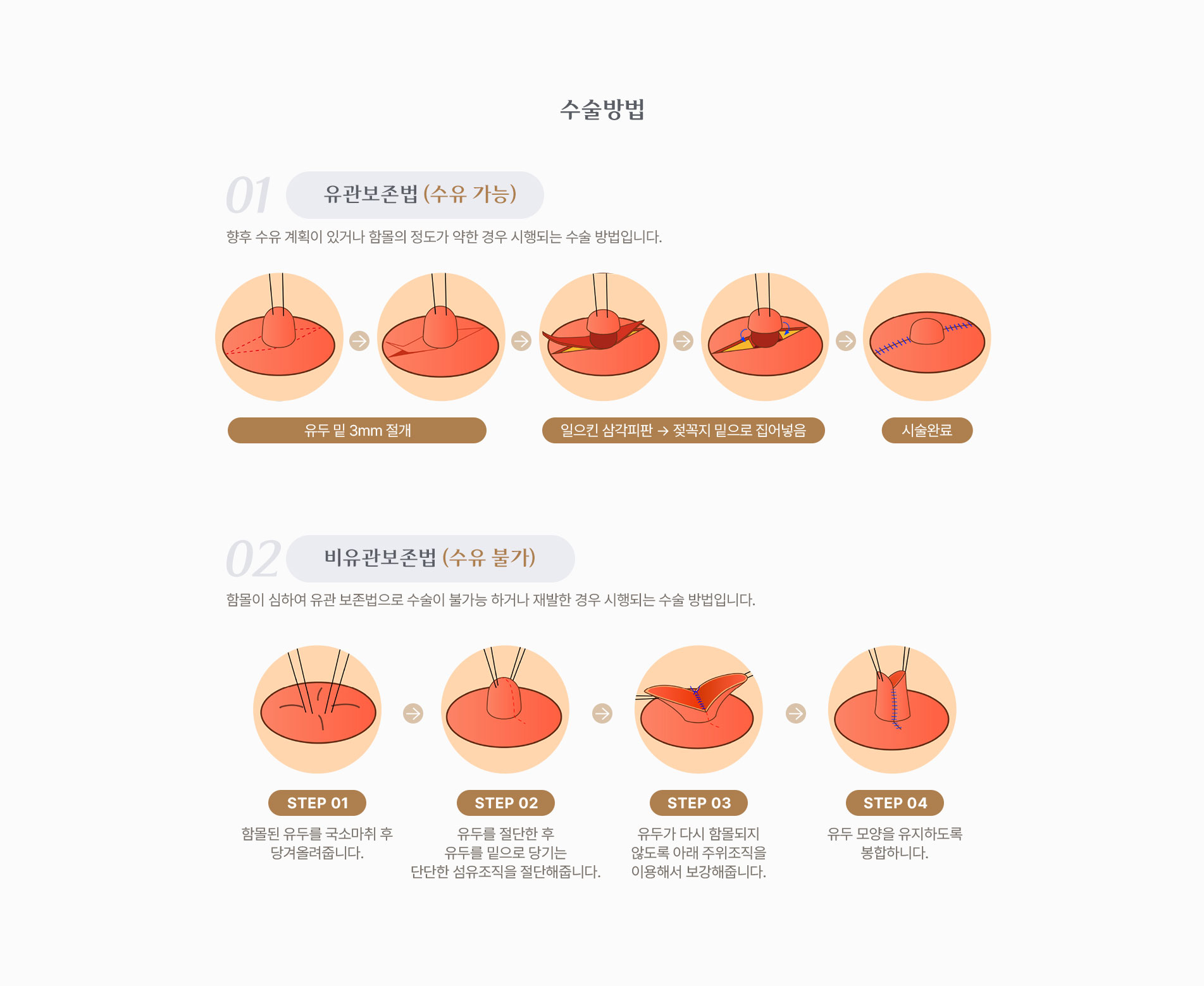 함몰유두 수술방법