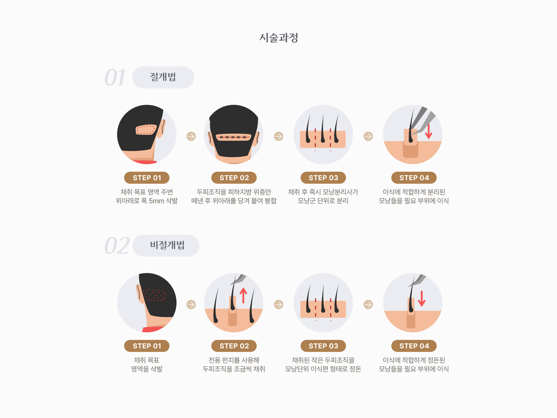 모발이식 시술과정