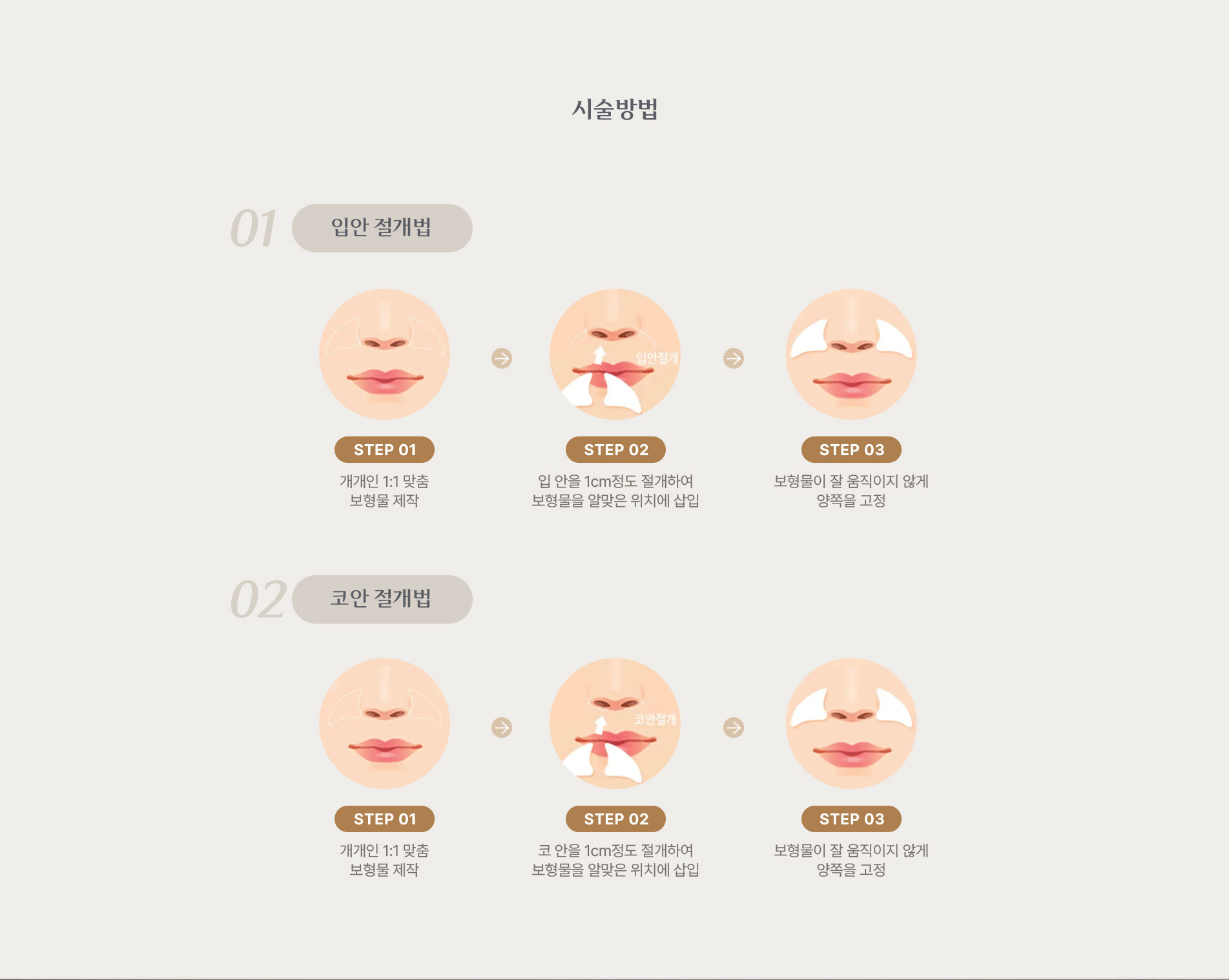 귀족수술 시술방법