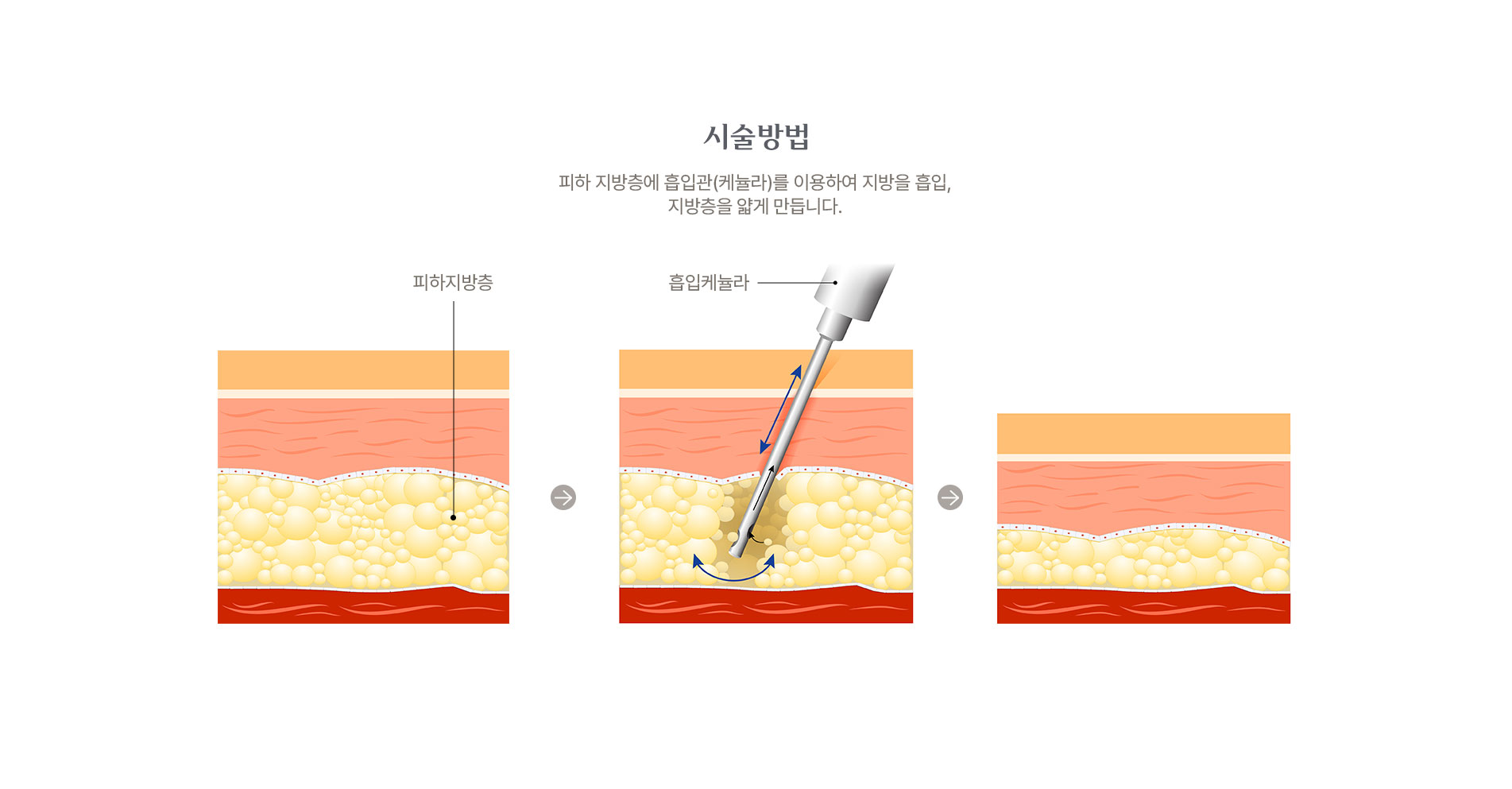 지방흡입술 시술방법 