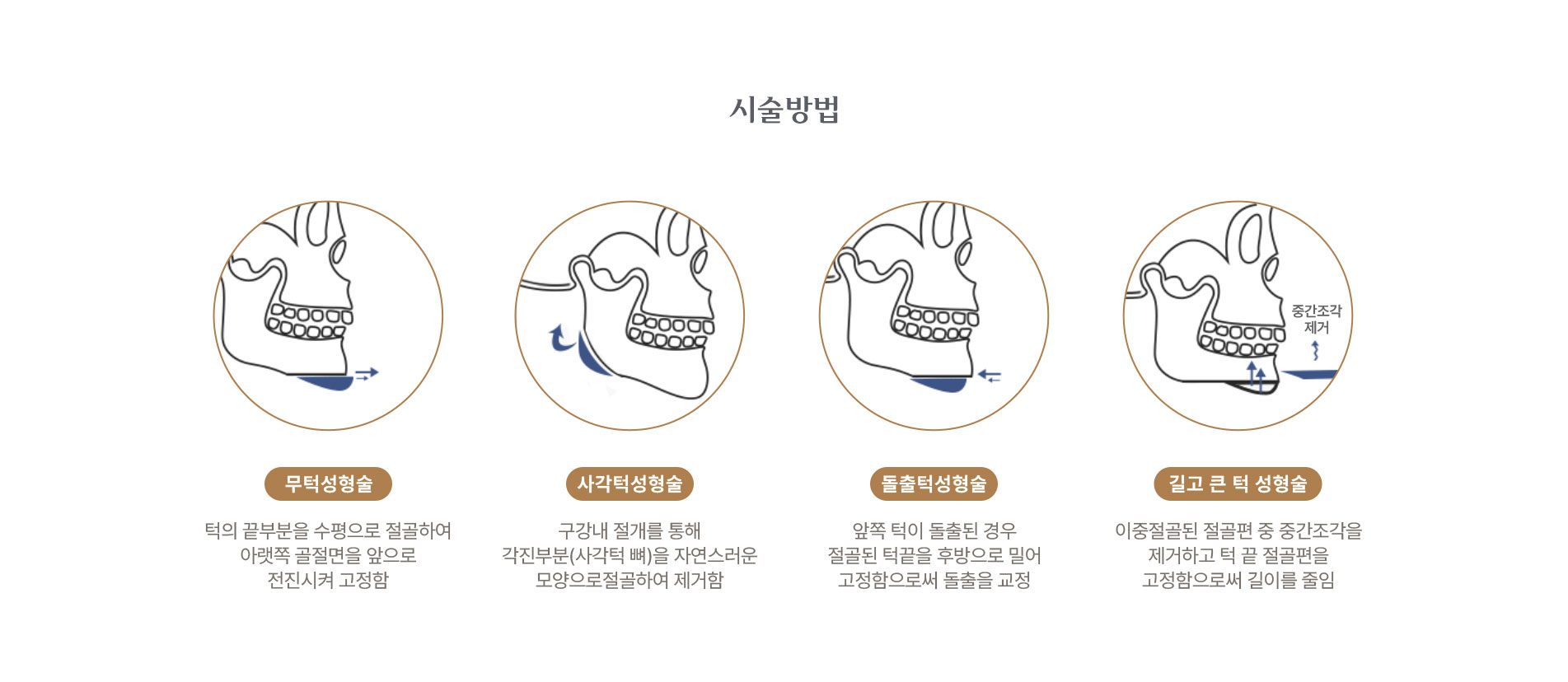 턱성형술 시술방법 
