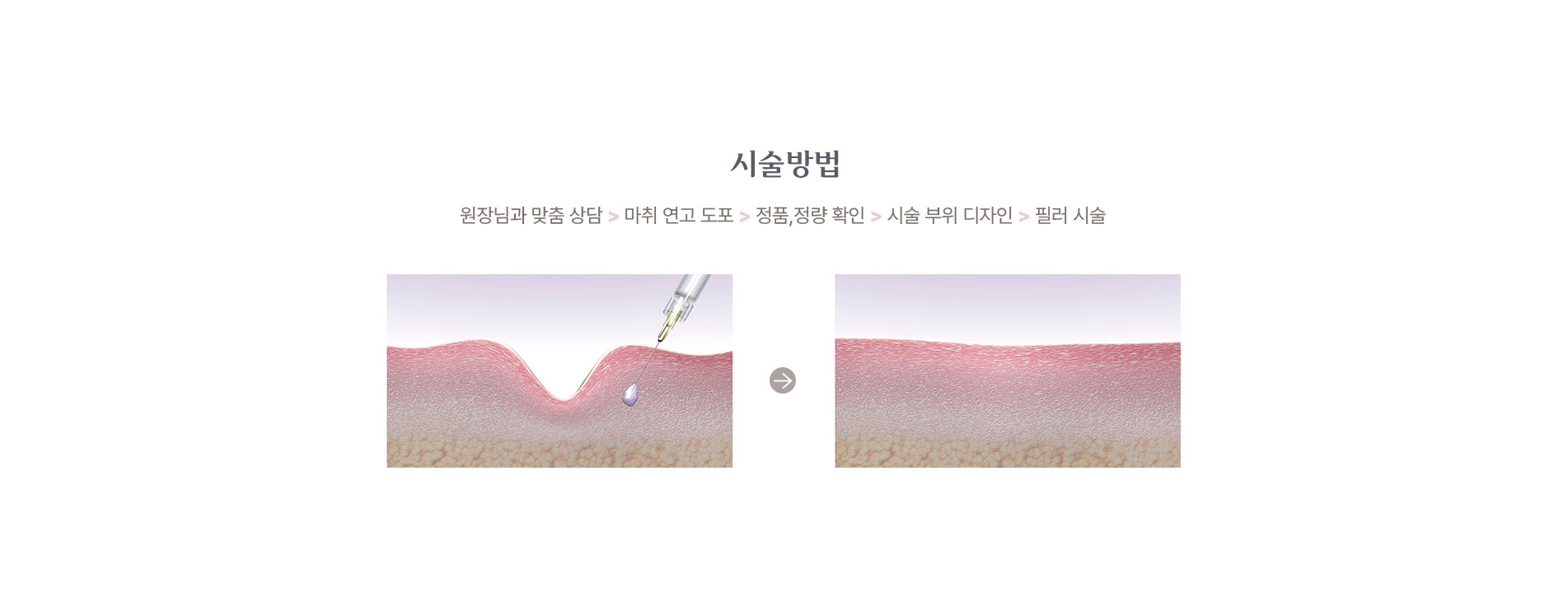 필러 시술방법 