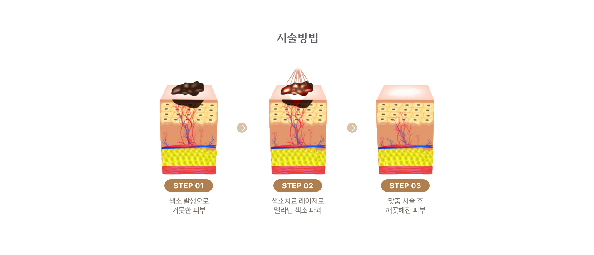 시술 방법 
