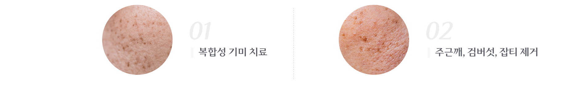 복합성 기미치료 , 주근깨/검버섯/잡티 제거
