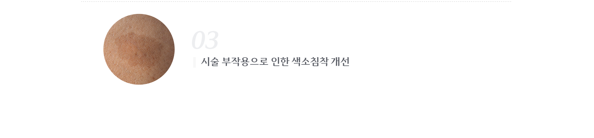 시술 부작용으로 인한 색소침착 개선 