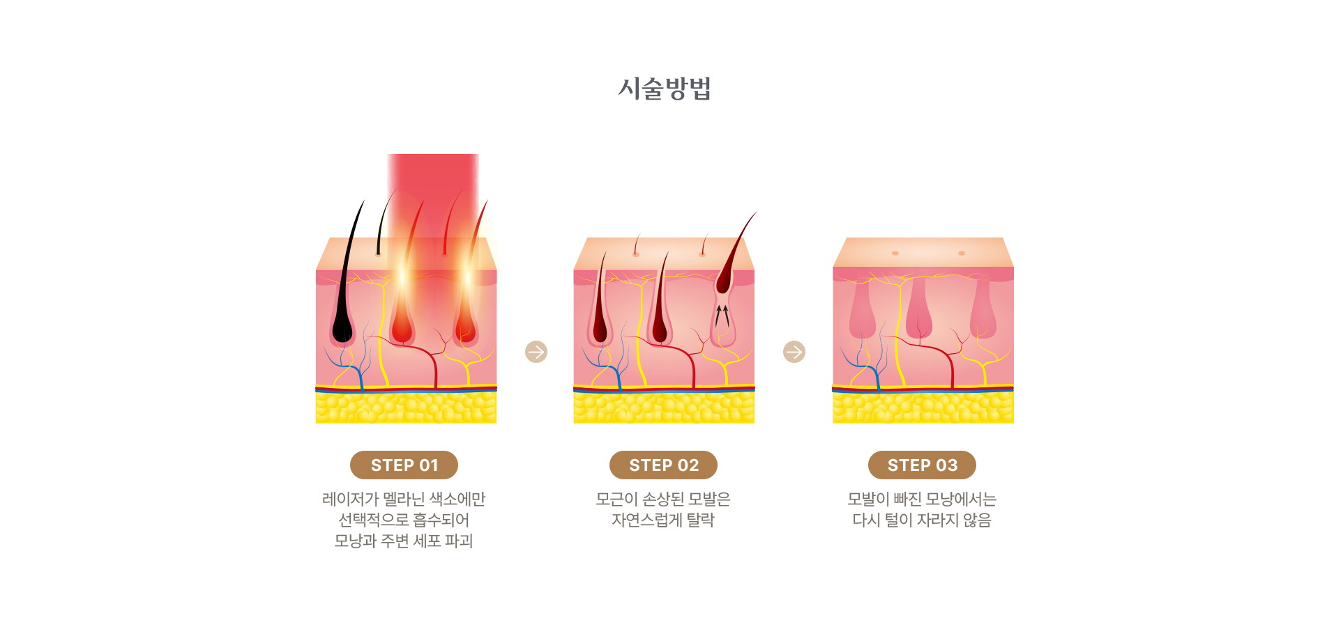 시술 방법